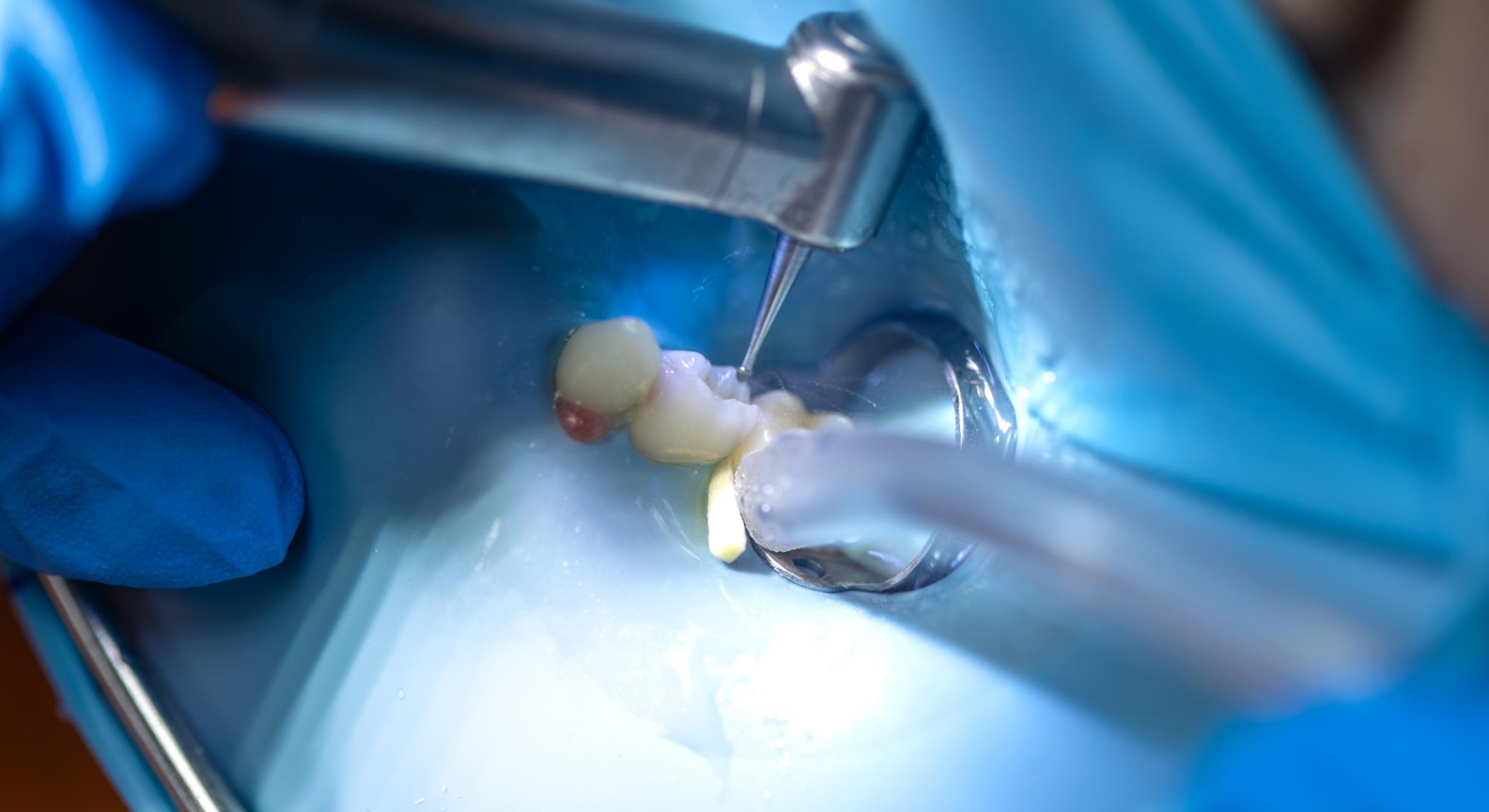 Can Nano Hydroxyapatite Replace Fluoride? What Dental Professionals Need to Know